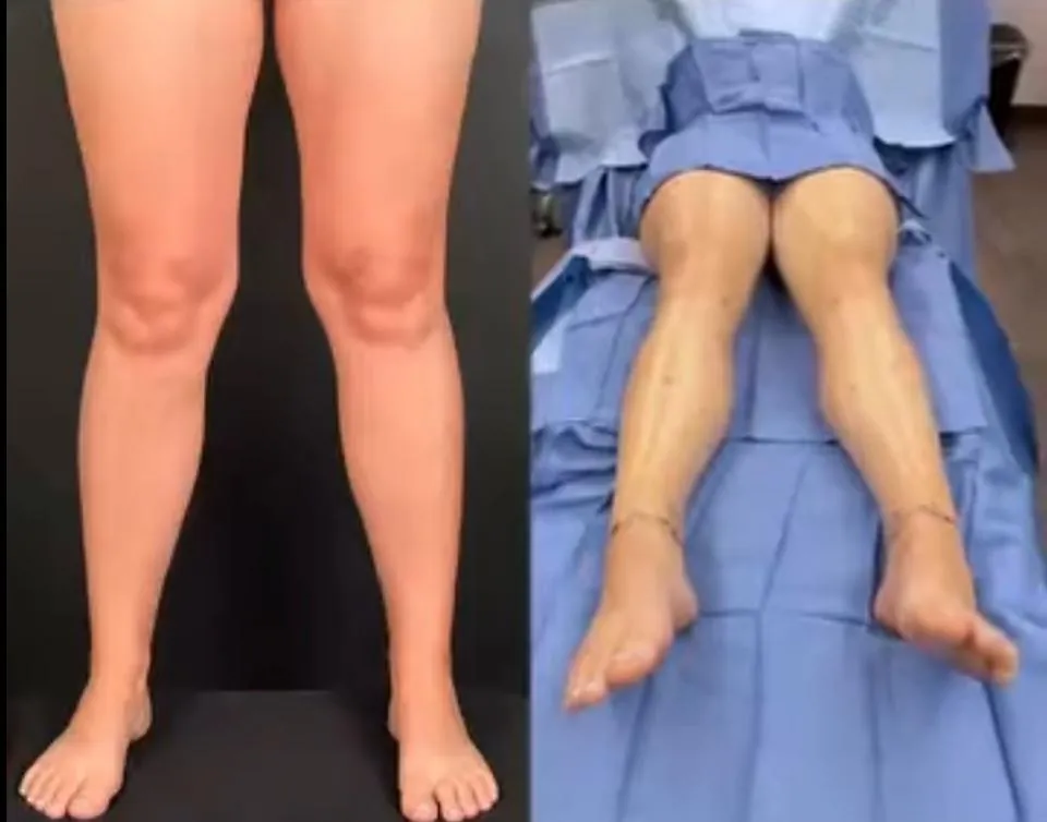 Lipœdème des jambes – avant / après liposuccion WAL, photo 4